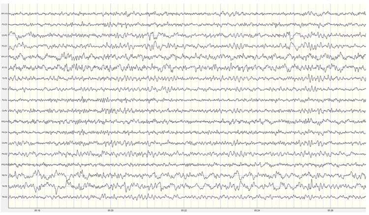 Second recording longitudinal bipolar montage showing improved symmetry